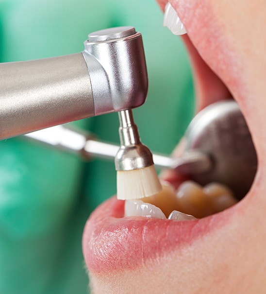 igiene-orale-parodontite