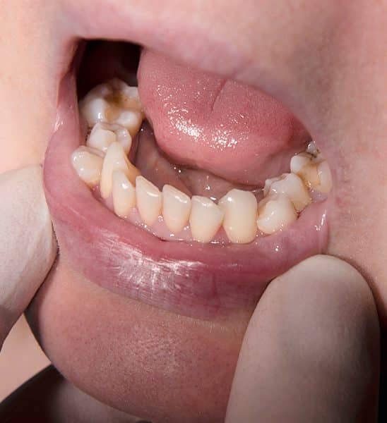 malocclusioni dentali