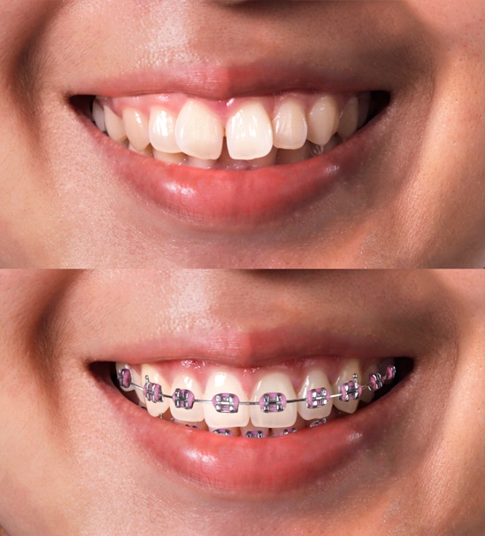 ortodonzia-prima-dopo