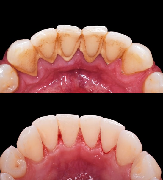 placca-batterica-tartaro