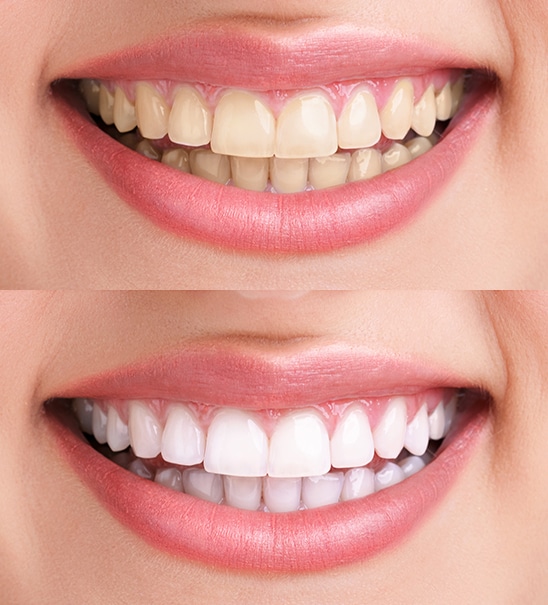 sbiancamento dentale-prima-dopo
