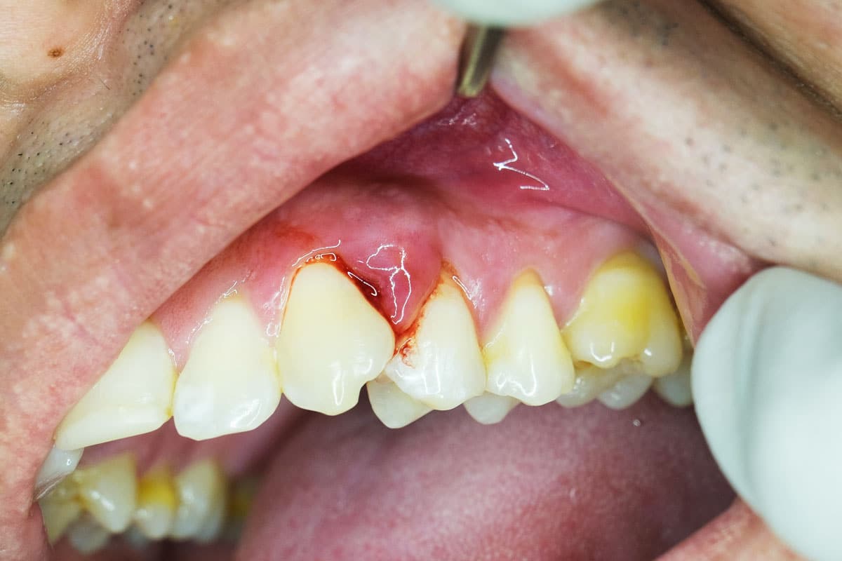 denti con parodontite