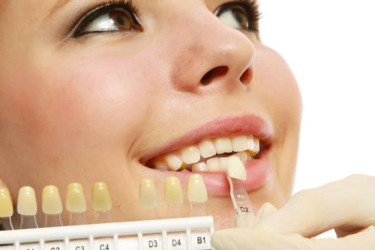 faccette dentali per curare i denti rotti