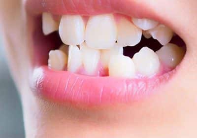 malocclusione dentale le 3 classi