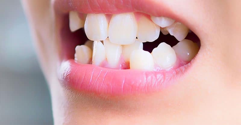 Malocclusione dentale: Cos’è, le 3 classi, e i rimedi