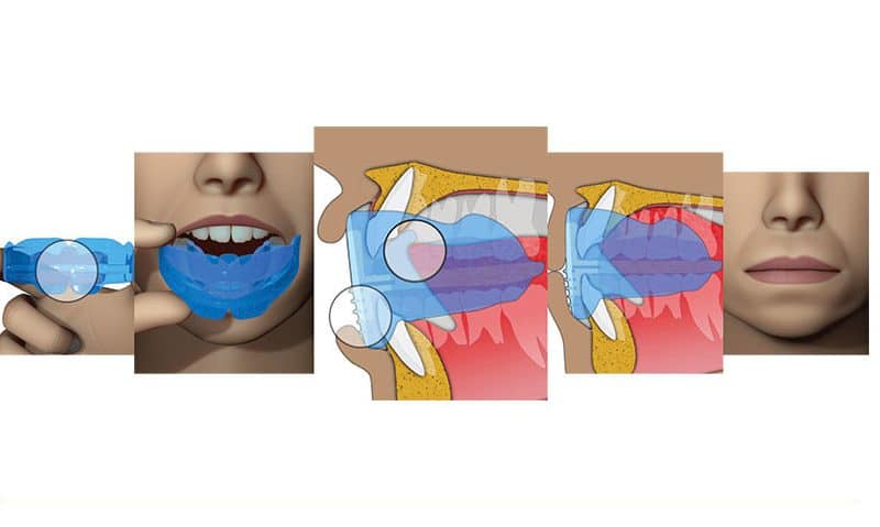 Cos’è il Myobrace: l’ortodonzia miofunzionale a Firenze