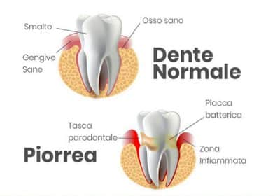 cause e sintomi della Piorrea