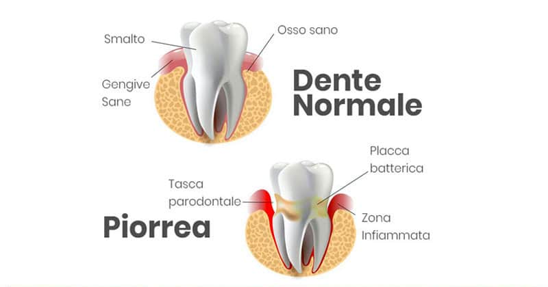 cause e sintomi della Piorrea