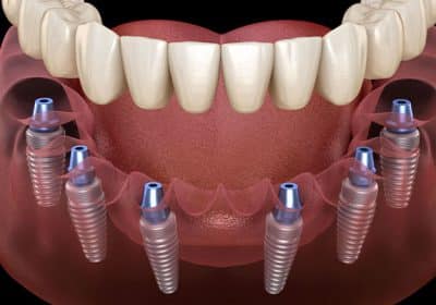 quanto dura un impianto dentale