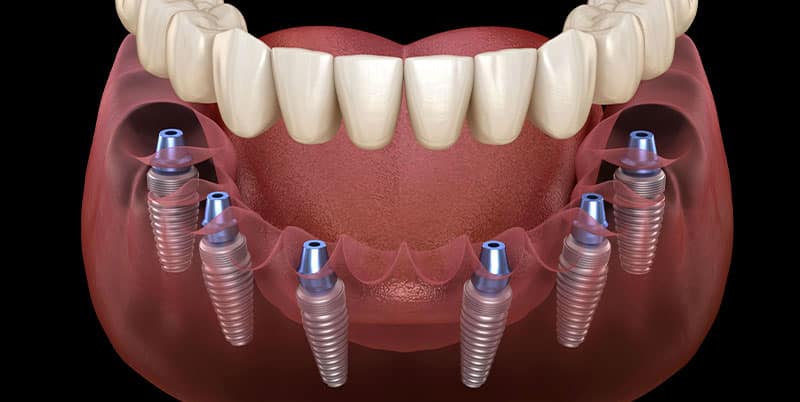 Quanto dura un impianto dentale