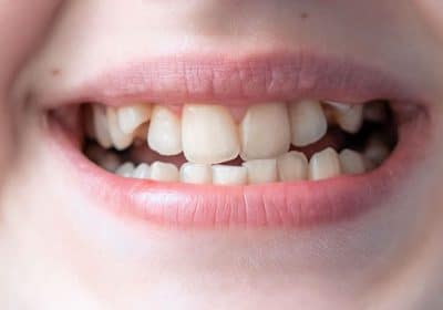 Raddirizzare i denti storti senza apparecchio: L'alternativa con Myobrace