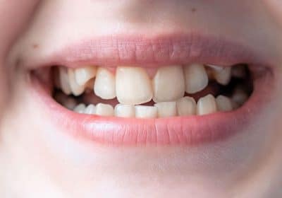 raddrizzare i denti storti senza apparecchio