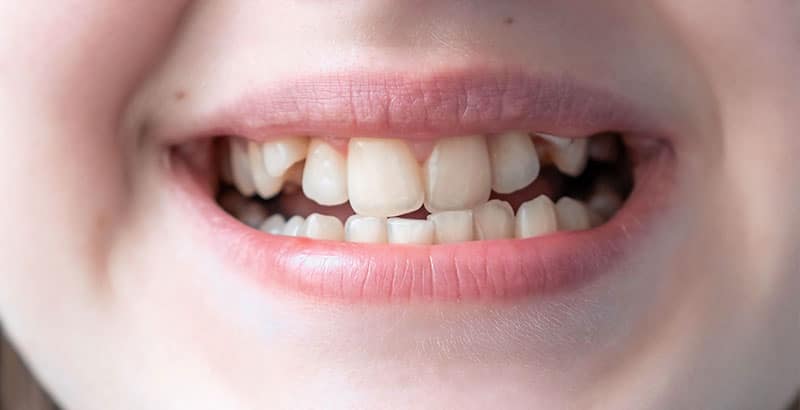 Raddrizzare i denti storti senza apparecchio: Myobrace e faccette