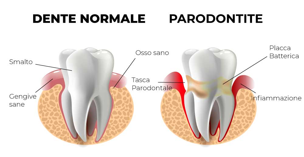 sintomi della parodontite