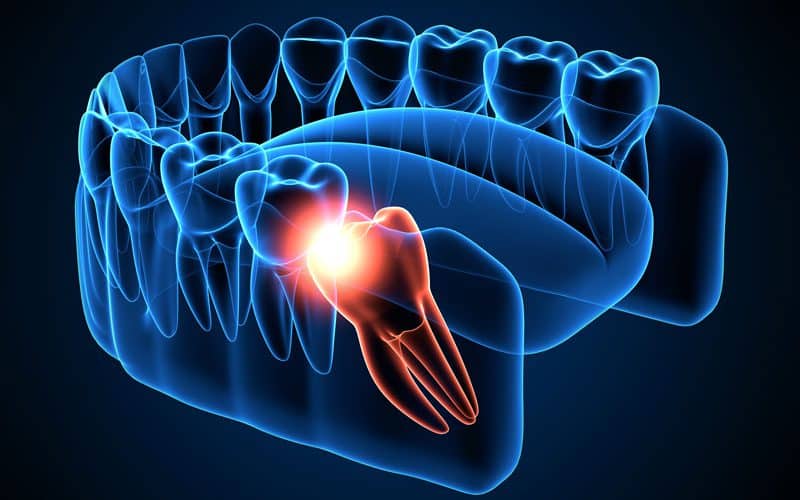 Quando togliere il dente del giudizio?