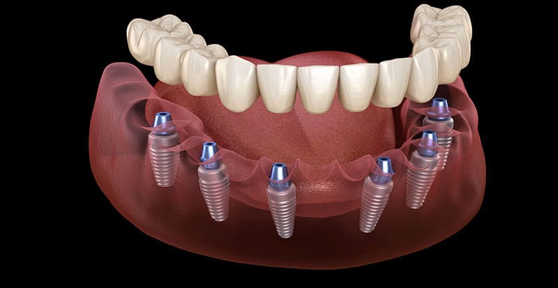 Toronto Bridge: denti fissi su 4 impianti per riabilitare un’intera arcata dentale