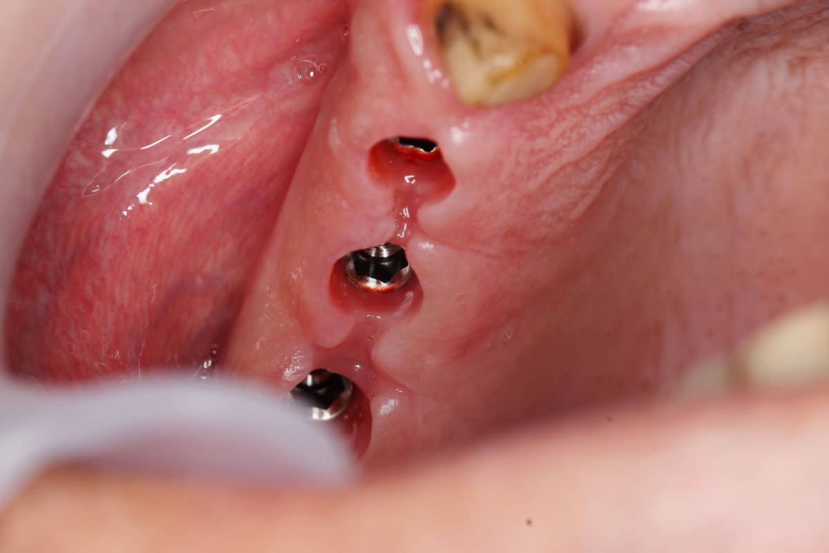 Impianti dentali transmucosi cosa sono e quando usarli