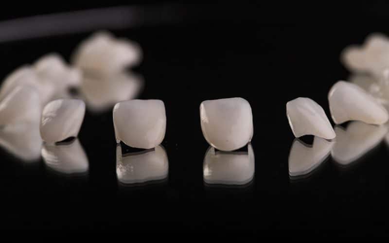 Faccette dentali dalla A alla Z: tutto quello che devi sapere