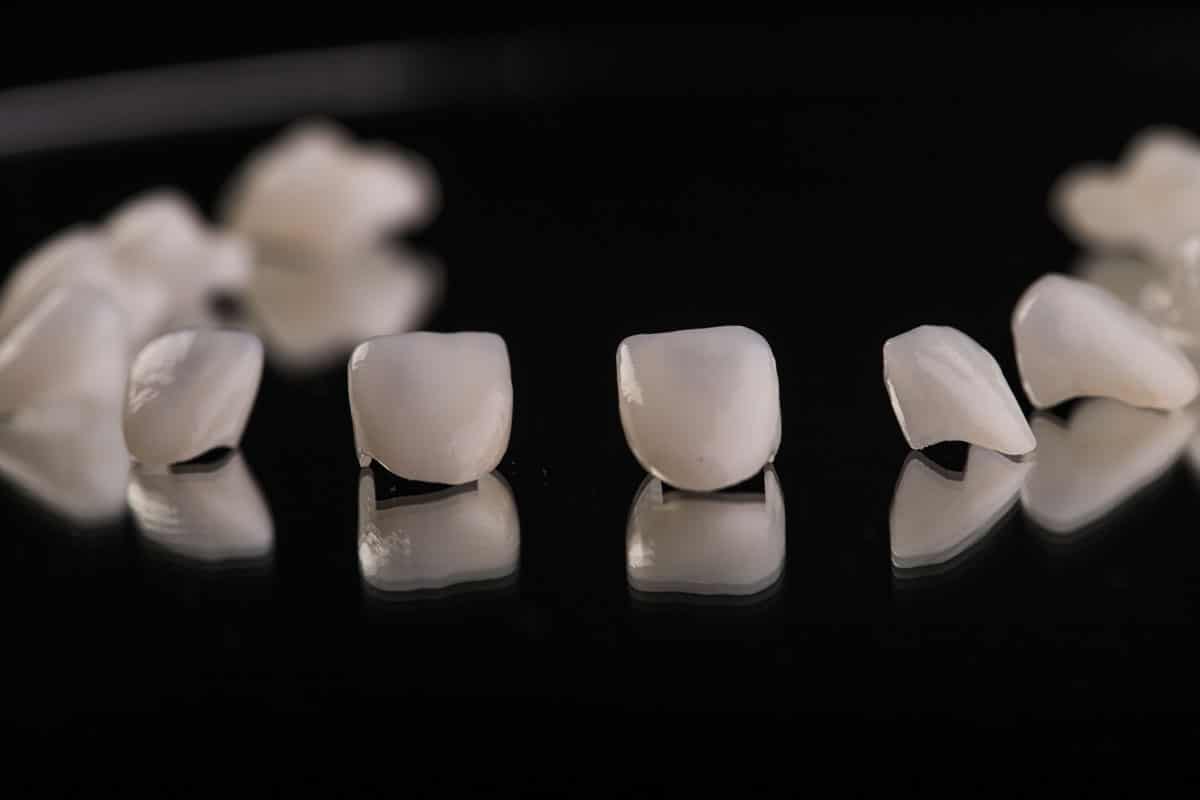 Faccette dentali dalla A alla Z: tutto quello che devi sapere