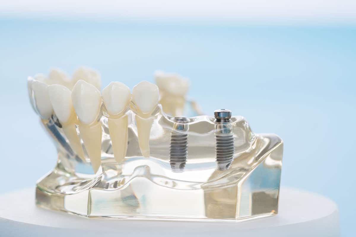 Impianti dentali a carico immediato