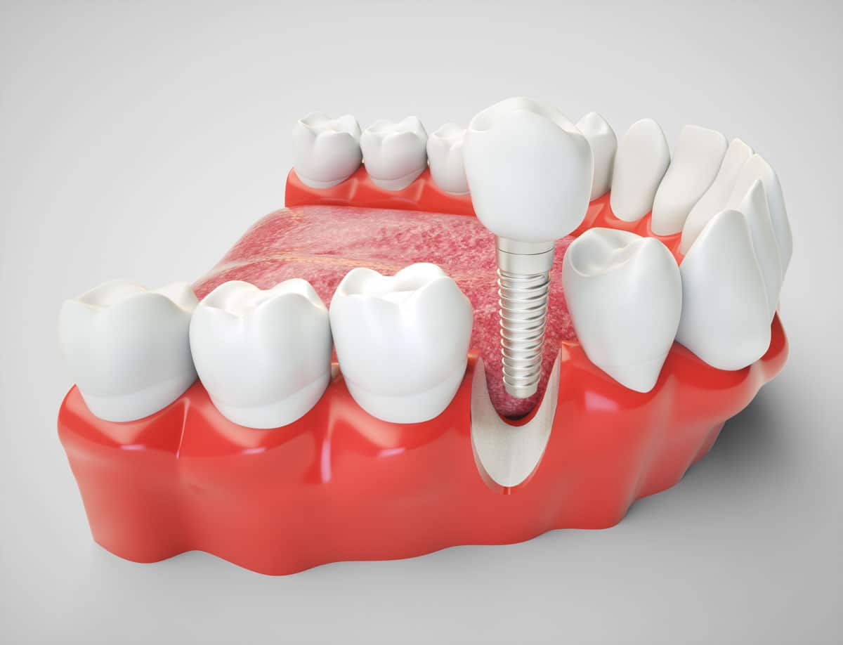 Impianti Dentali a Ponsacco: Denti Fissi anche in 24 Ore e con Poco Osso