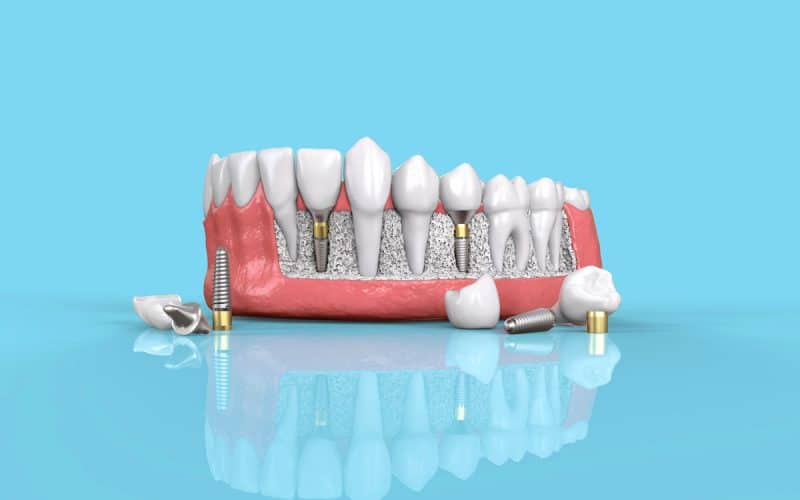 Impianto dentale: Tutto quello che c’è da sapere