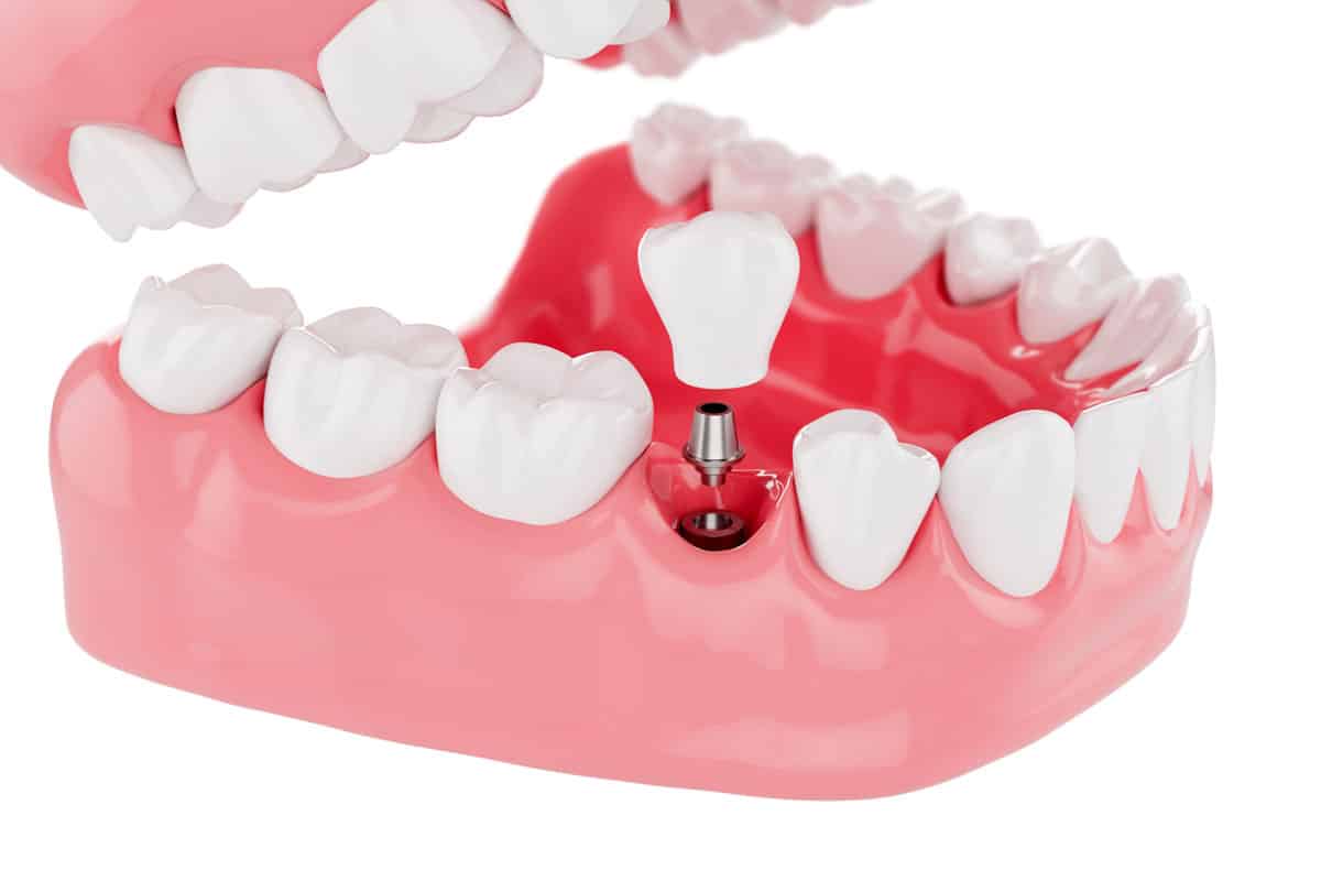 impianto dentale quando manca un dente