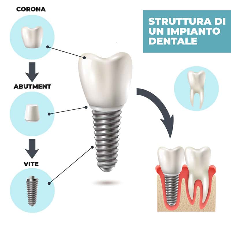 struttura di un impianto dentale