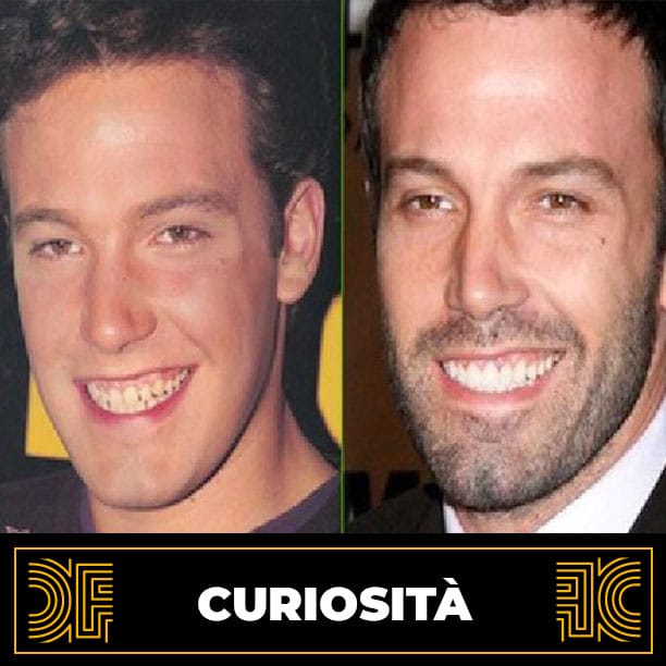 faccette dentali ben Affleck