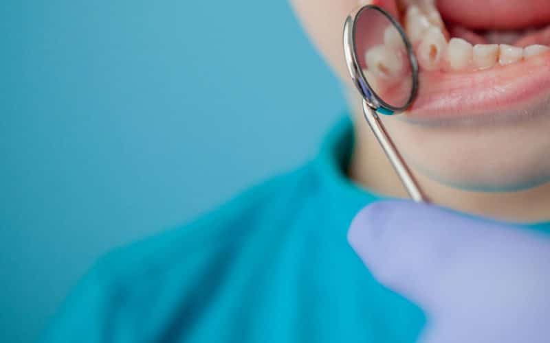 Carie dentale: cos’è, cura, denti colpiti