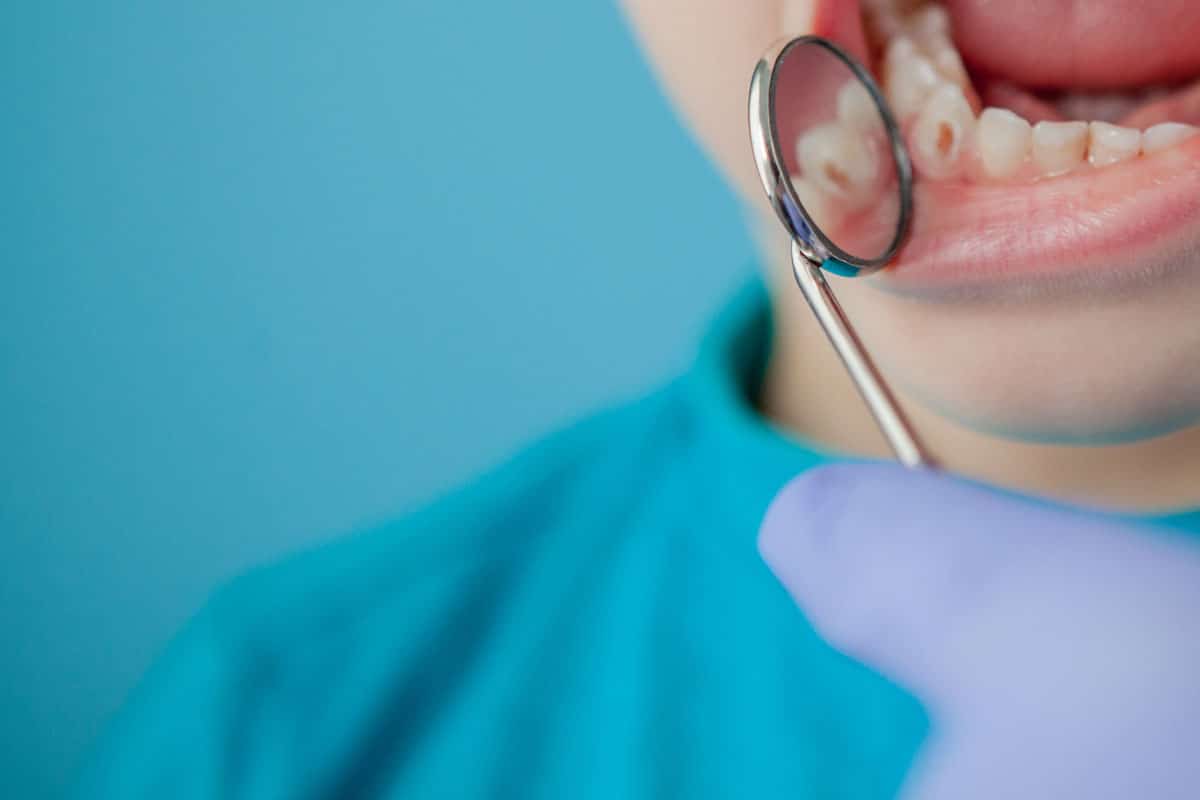 Carie dentale: cos’è, cura, denti colpiti