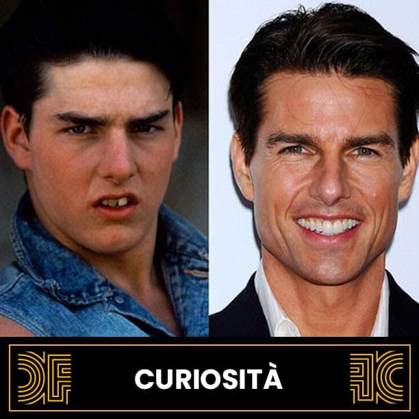 faccette dentali Tom Cruise