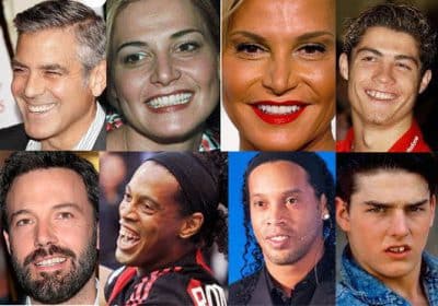 faccette dentali vip