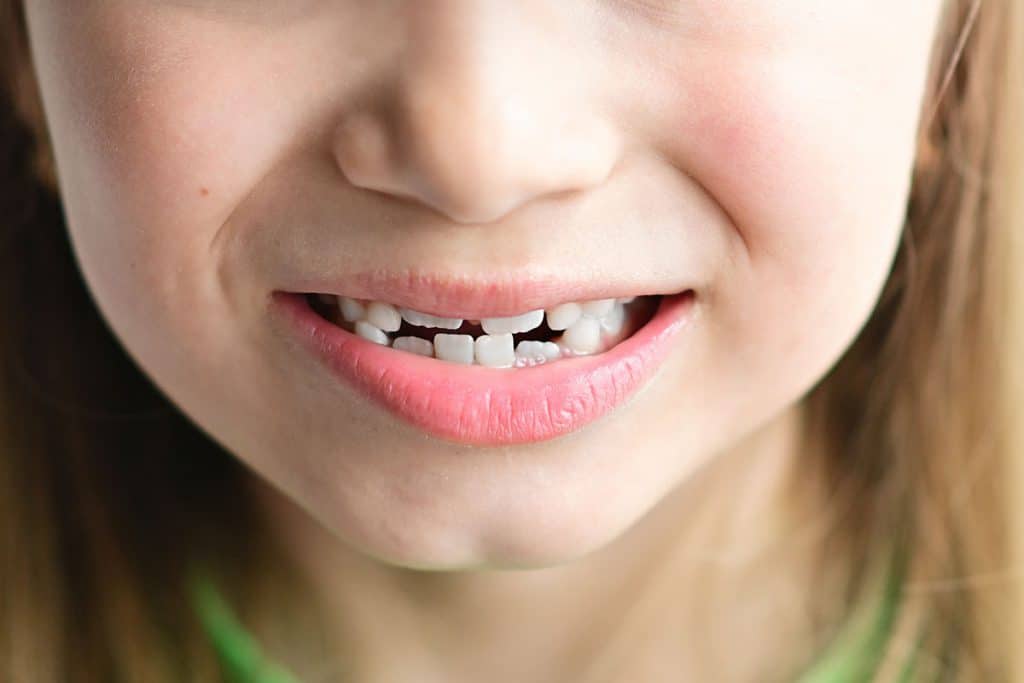 raddrizzare i denti storti