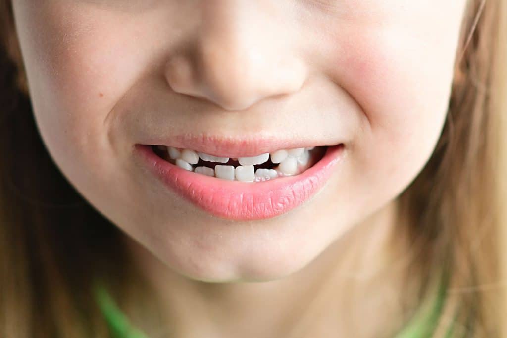 raddrizzare i denti storti