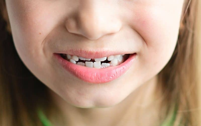 Denti storti: cause, conseguenze, come raddrizzarli e costi