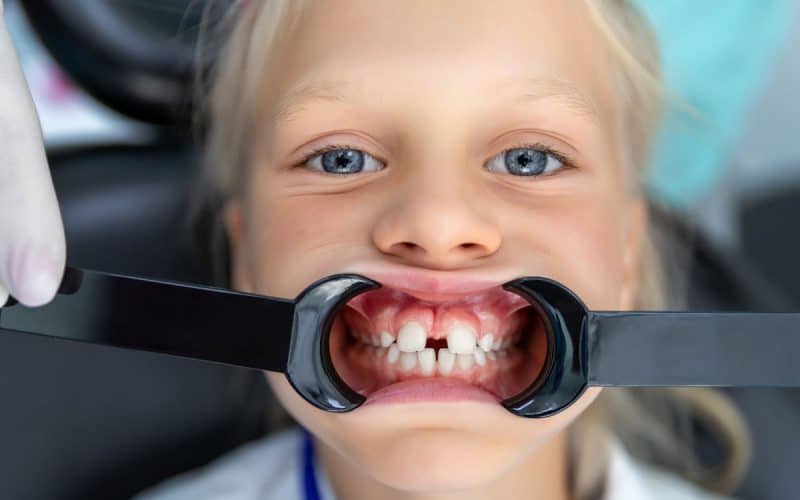 Diastema dentale: Come correggere i denti separati con l’ortodonzia