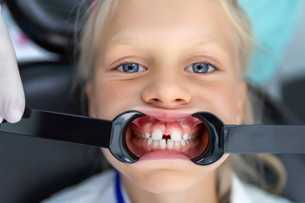 Diastema dentale: Come correggere i denti separati con l’ortodonzia