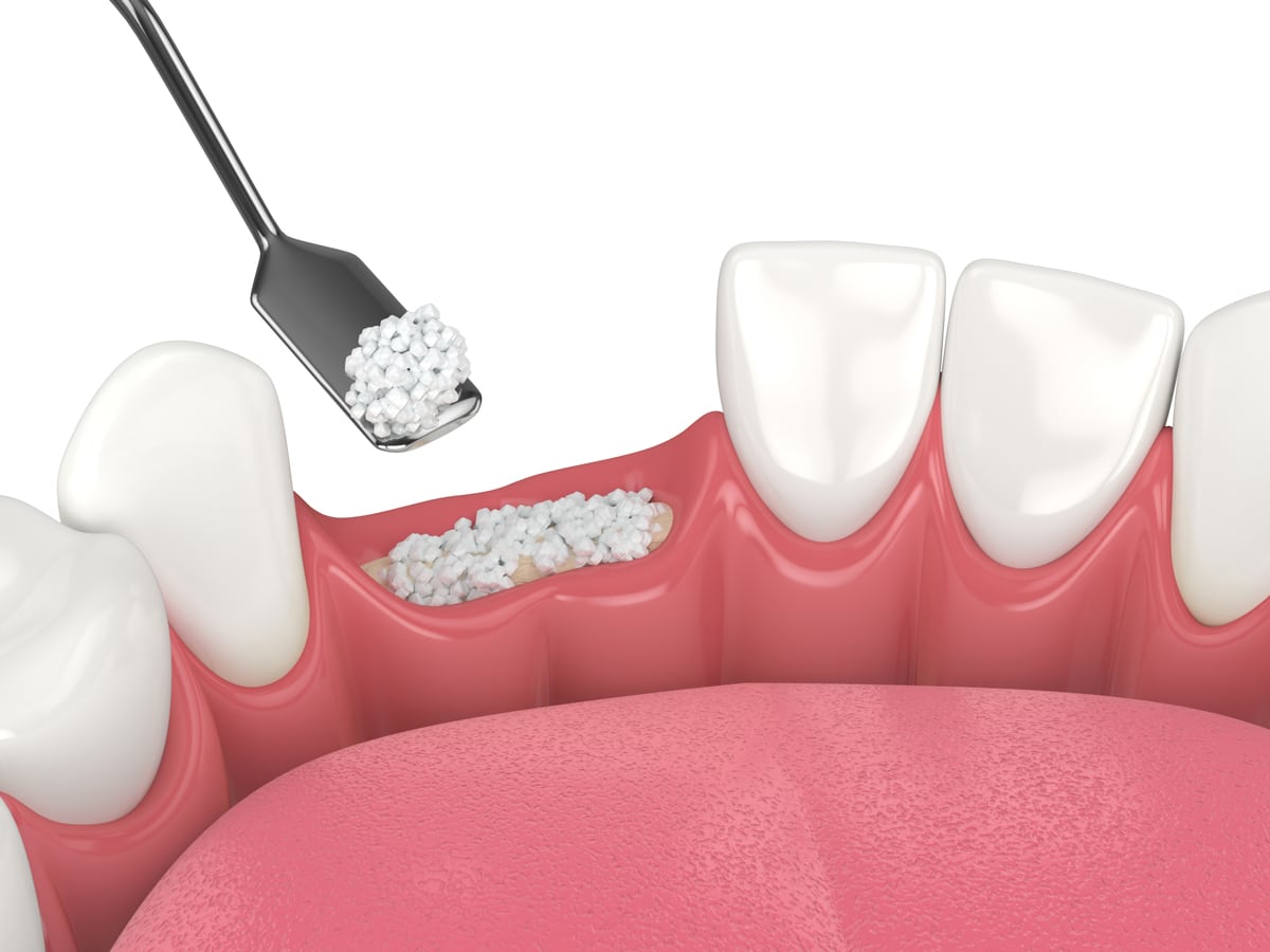 Innesto osseo dentale: mettere gli impianti con poco osso