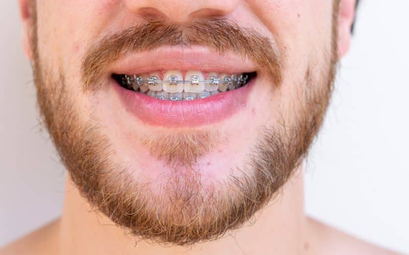 Apparecchio fisso trasparente: vantaggi e svantaggi