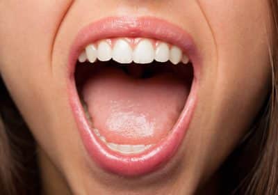 Morso aperto: cos’è  e come correggerlo con l’ortodonzia