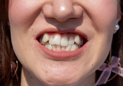 Affollamento dentale: cos'è e come correggerlo con l'ortodonzia