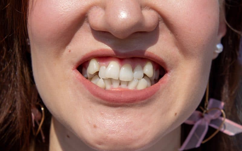 Affollamento dentale: cos’è e come correggerlo con l’ortodonzia