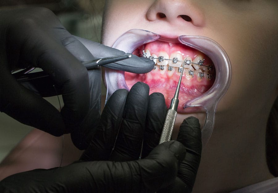 Dentista che applica apparecchio fisso metallico