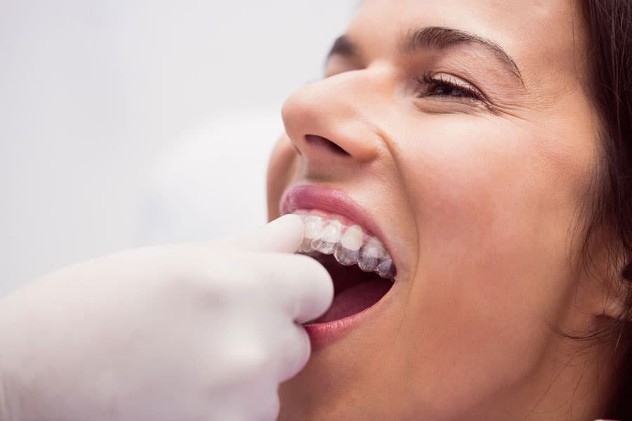 dentista applica apparecchio trasparente invisalign