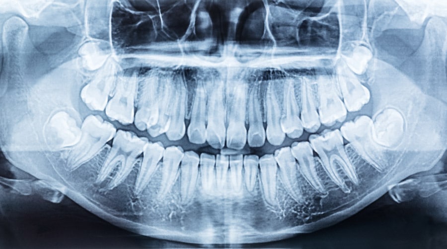 lastra rx con denti sovrapposti