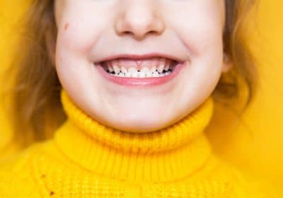 Morso crociato: cos'è, cause e come correggerlo con l'ortodonzia