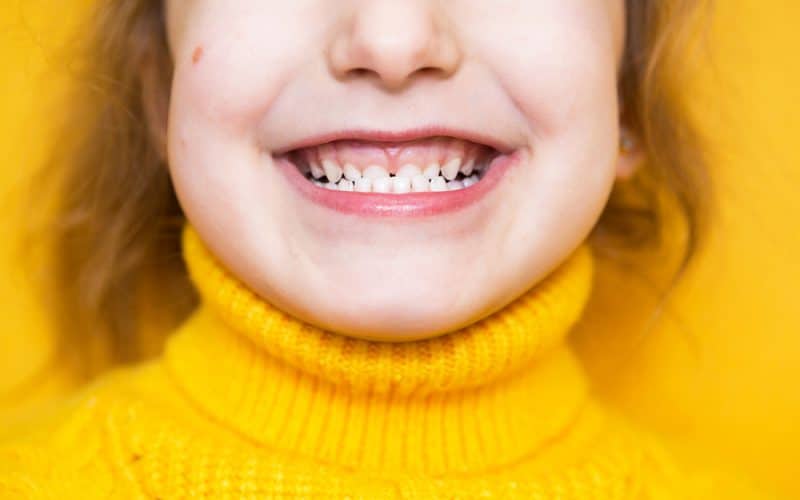 Morso crociato: cos’è, cause e come correggerlo con l’ortodonzia
