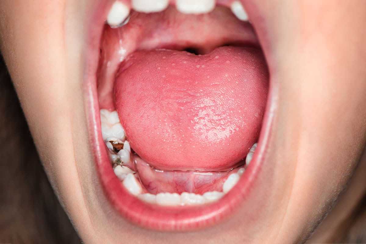 Molare rotto o dente spezzato: cosa fare subito, quando si ricostruisce e quando si toglie