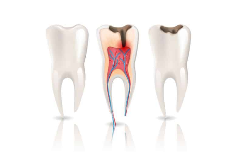 Pulpite dentale: cos’è, sintomi e cura